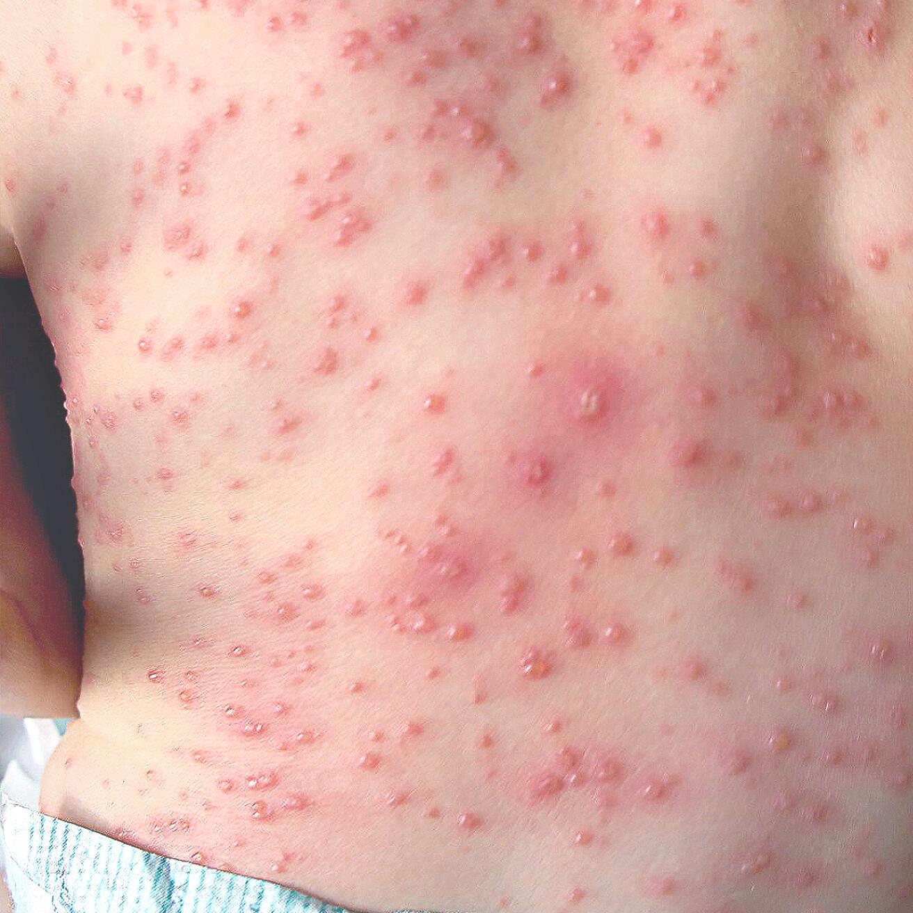 Sår hud med utbredt utslett og hudirritasjon, der riktig sårheling kan bidra til å redusere arr og forebygge varige merker